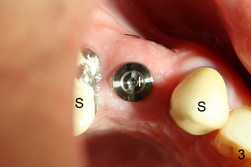 Implant is a Preventive Measure gum bone shrink after tooth extraction